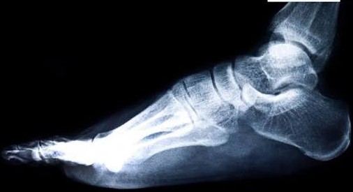 CT Scan (L) Elbow 